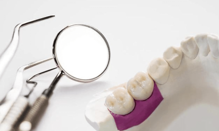Why Choose A Dental Bridge Over Other Tooth Replacement Options