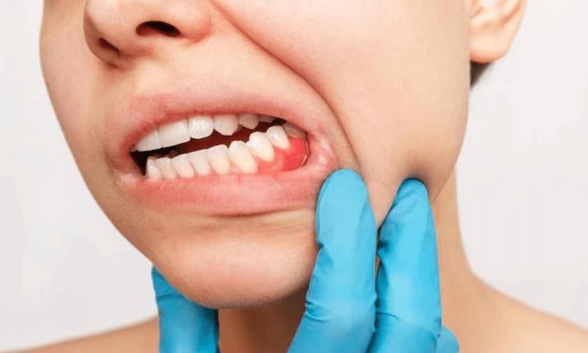 Recognizing The Signs Of Periodontal Disease