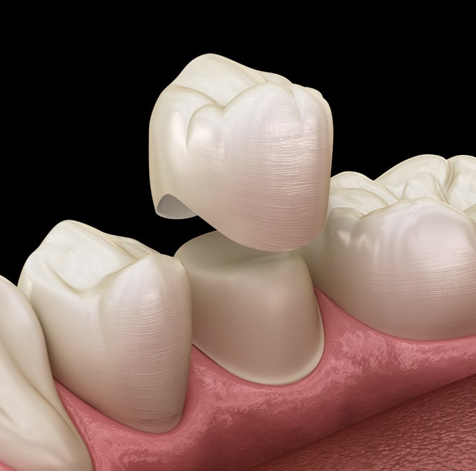 Dental crowns displayed on gum model showing tooth restoration and prosthetic dentistry procedure.
