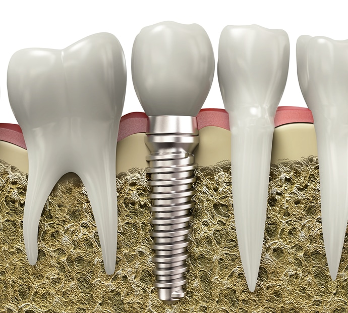 Dental implant illustration showing tooth replacement procedure with crown, screw, and adjacent natural teeth in jawbone.