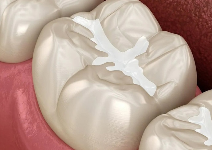 Dental crown restoration showing tooth preparation and provisional restoration on molar tooth.