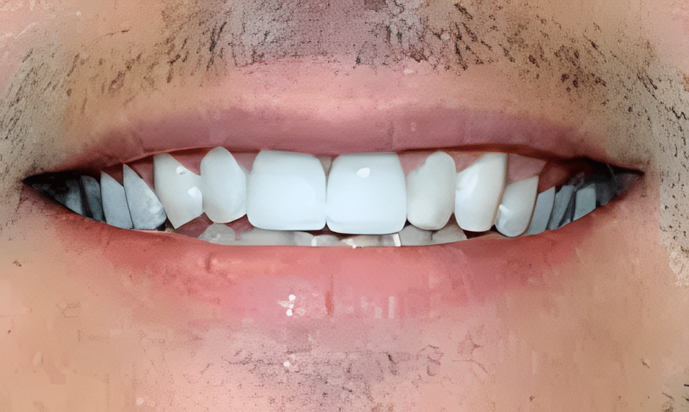 Close-up of person's smile showing white teeth and natural pink lips against skin tone.