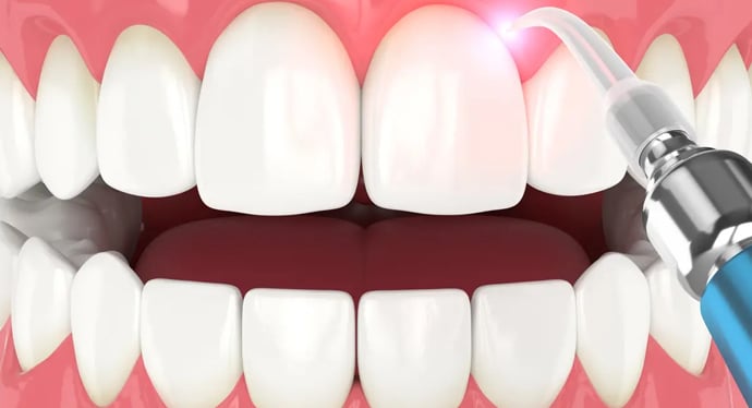 Dental cleaning illustration showing upper and lower teeth with hygiene tool removing plaque.