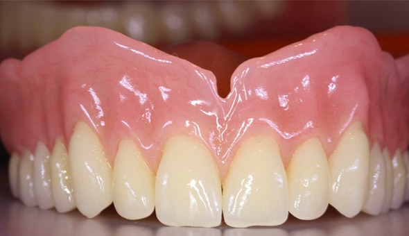 Close-up dental prosthetic showing upper front teeth with pink gum tissue and cream-colored tooth crowns.