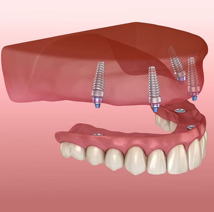 3D dental implant illustration showing upper jaw model with four titanium screws and prosthetic teeth on pink background.