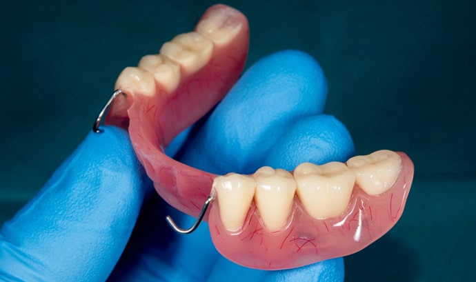 Dental professional in blue gloves holding removable denture prosthetic showing tooth replacement solution.