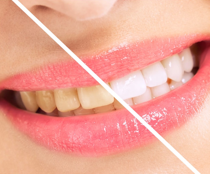 Before and after teeth whitening comparison showing yellowed teeth transforming to bright white teeth.