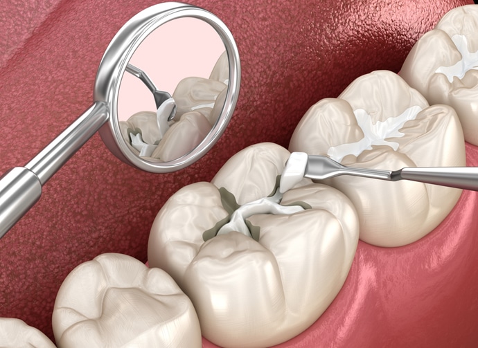 Dental mirror and explorer examining tooth surfaces during oral examination in clinical setting.