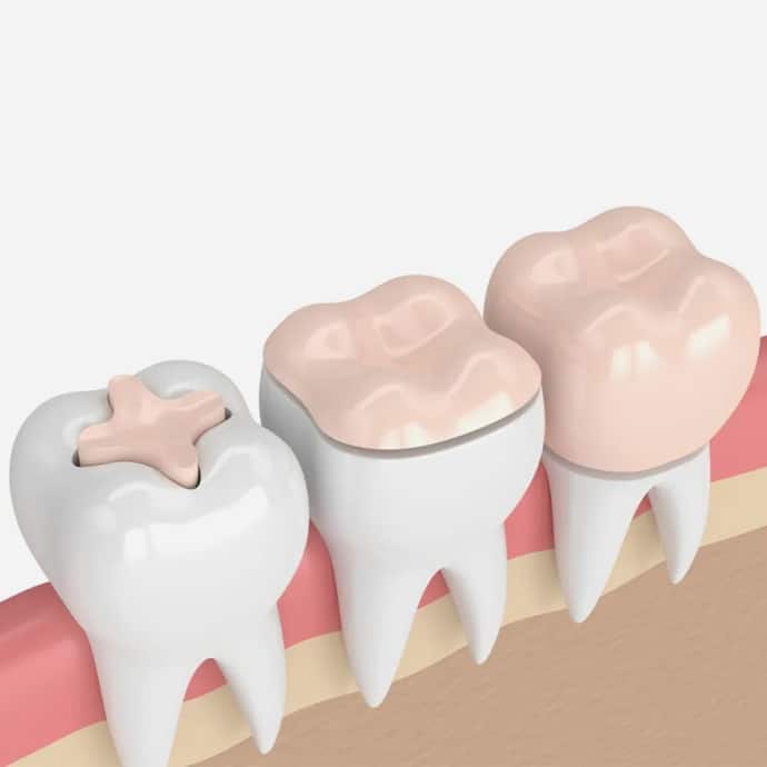 Four tooth models showing progression of dental crown placement on pink gum model background.